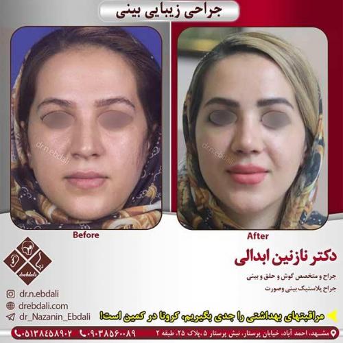 جراحی-بینی-مشهد-176