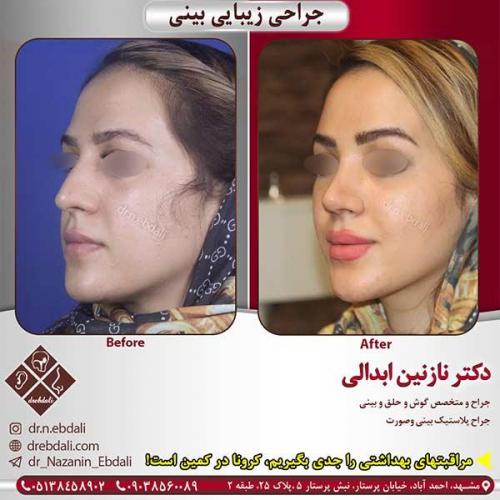 جراحی-بینی-مشهد-177