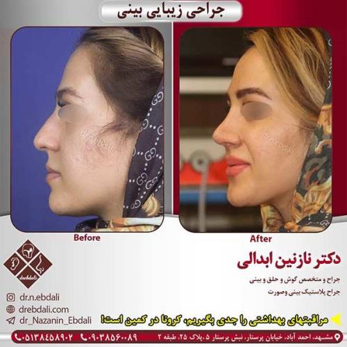 جراحی-بینی-مشهد-178
