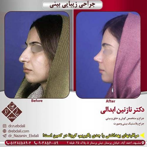 جراحی-بینی-مشهد-180