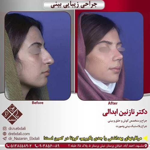 جراحی-بینی-مشهد-182