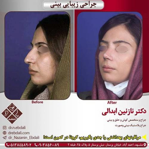 جراحی-بینی-مشهد-183