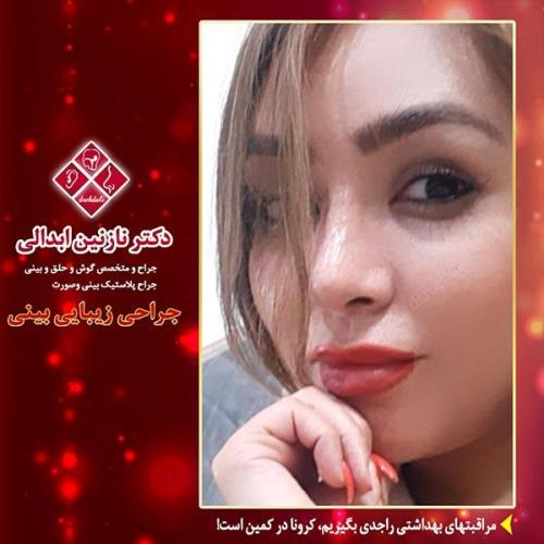 جراحی-بینی-مشهد-192