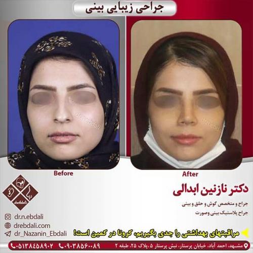 جراحی-بینی-مشهد-193