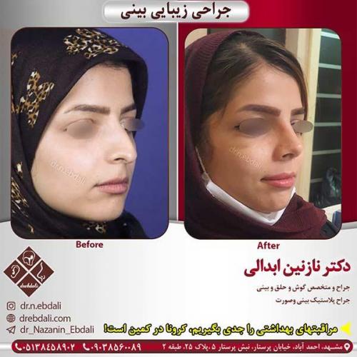 جراحی-بینی-مشهد-194