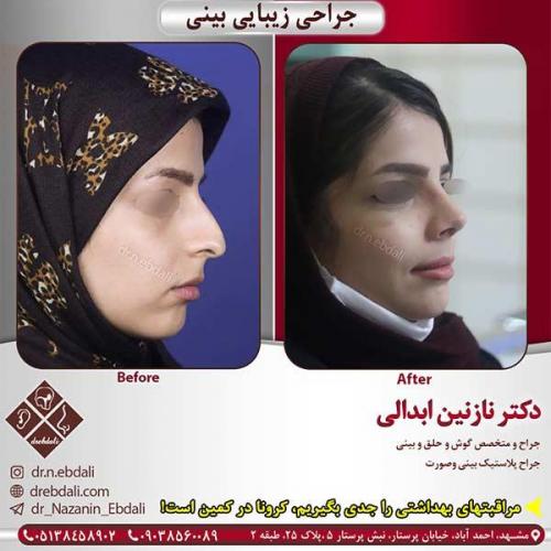 جراحی-بینی-مشهد-195