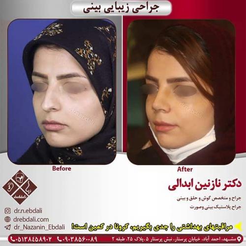جراحی-بینی-مشهد-196
