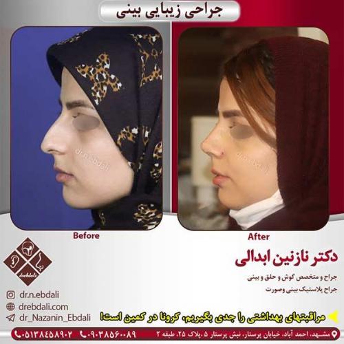 جراحی-بینی-مشهد-197