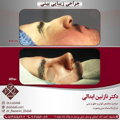 جراحی-بینی-مشهد-2