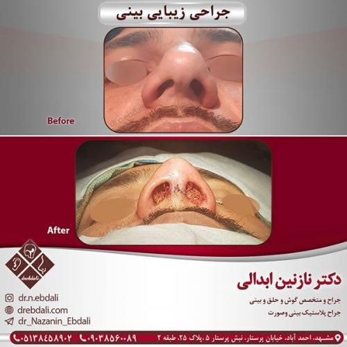 جراحی-بینی-مشهد-20