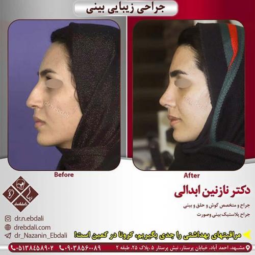 جراحی-بینی-مشهد-202