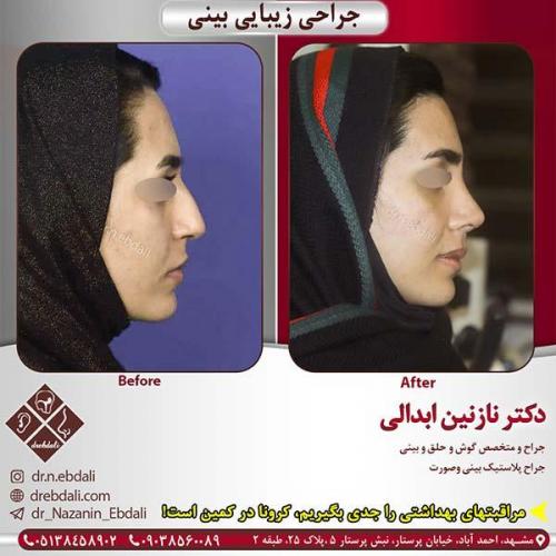جراحی-بینی-مشهد-203