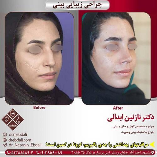 جراحی-بینی-مشهد-204
