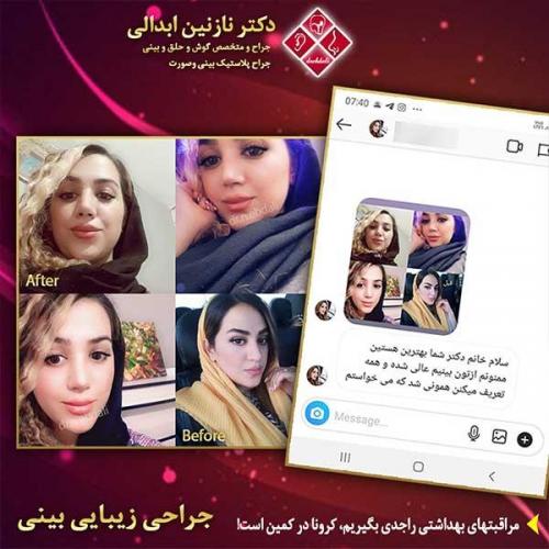 جراحی-بینی-مشهد-206