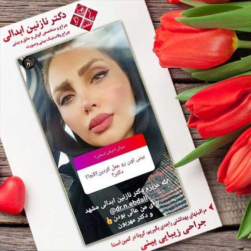 جراحی-بینی-مشهد-207