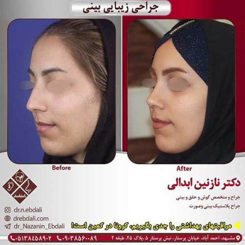 جراحی-بینی-مشهد-209