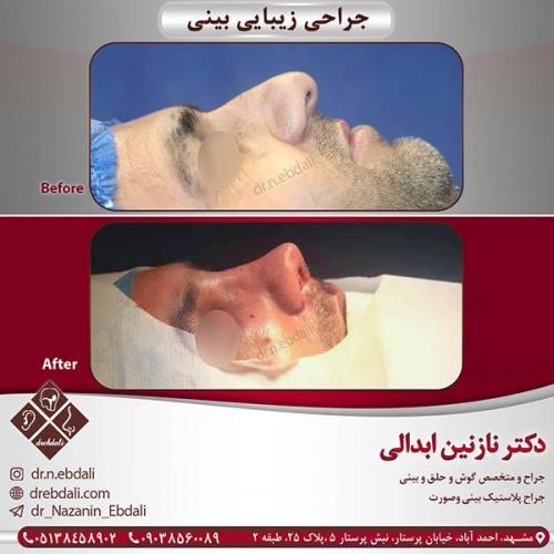 جراحی-بینی-مشهد-21