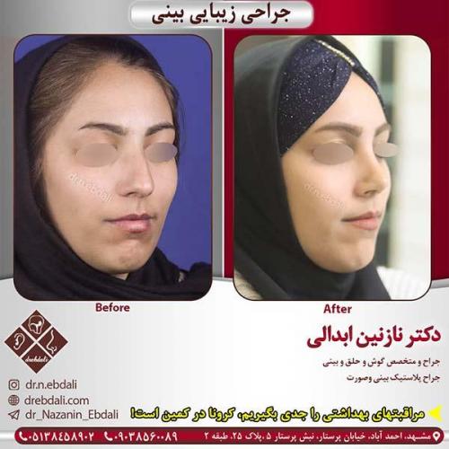جراحی-بینی-مشهد-210