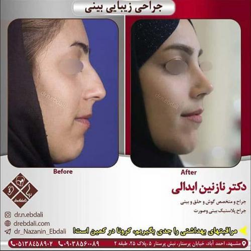 جراحی-بینی-مشهد-211
