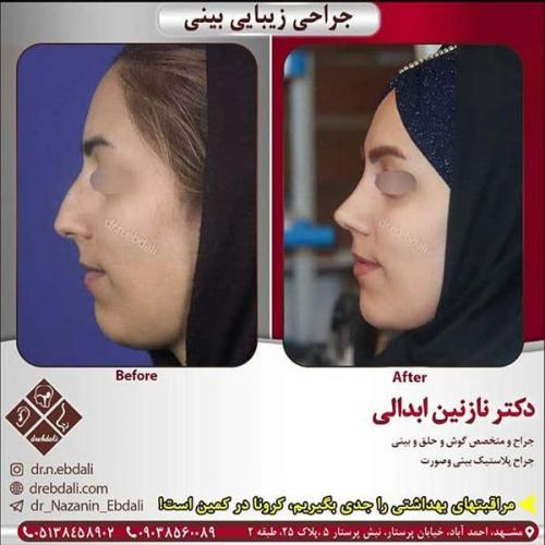 جراحی-بینی-مشهد-212