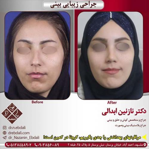 جراحی-بینی-مشهد-213