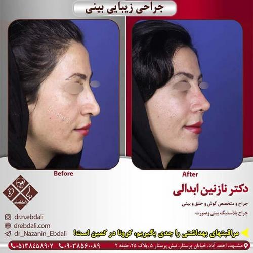 جراحی-بینی-مشهد-217