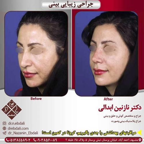 جراحی-بینی-مشهد-218