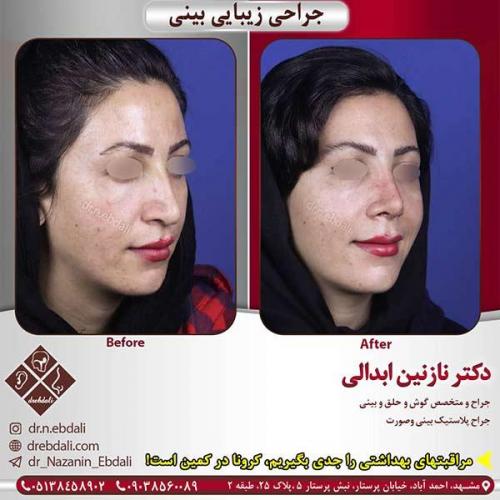جراحی-بینی-مشهد-219