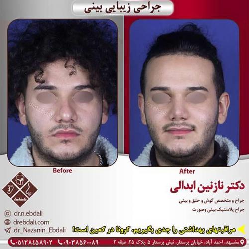 جراحی-بینی-مشهد-220
