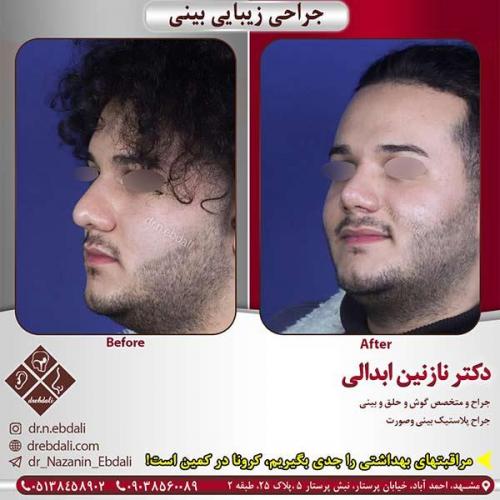 جراحی-بینی-مشهد-221