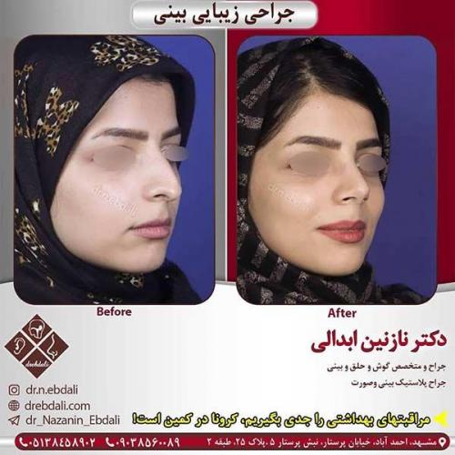 جراحی-بینی-مشهد-224