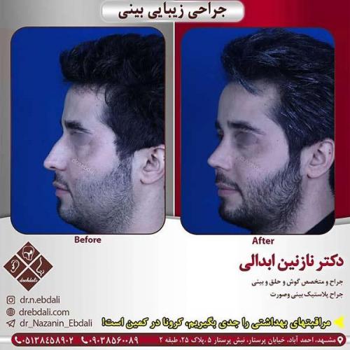 جراحی-بینی-مشهد-228