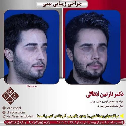 جراحی-بینی-مشهد-229