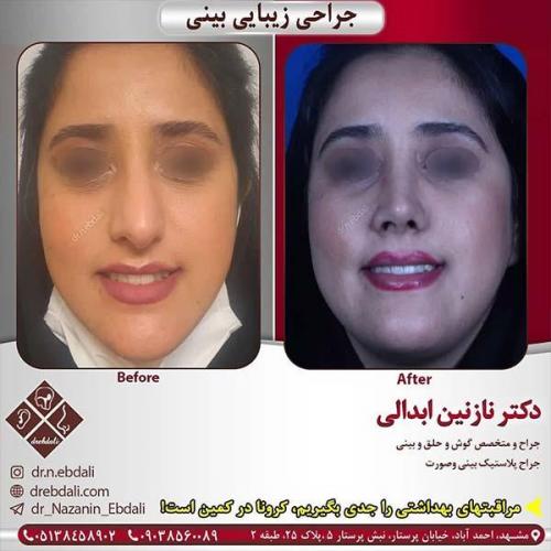 جراحی-بینی-مشهد-232