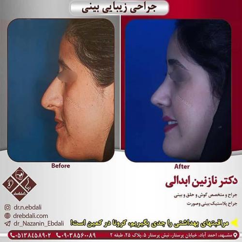جراحی-بینی-مشهد-233