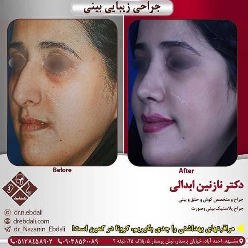 جراحی-بینی-مشهد-234