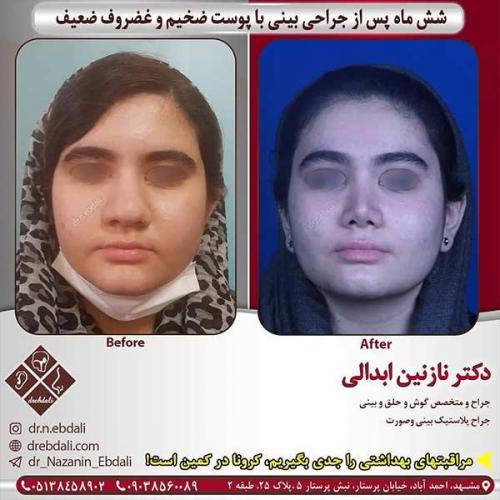 جراحی-بینی-مشهد-236