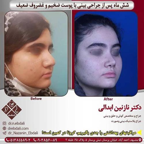 جراحی-بینی-مشهد-237