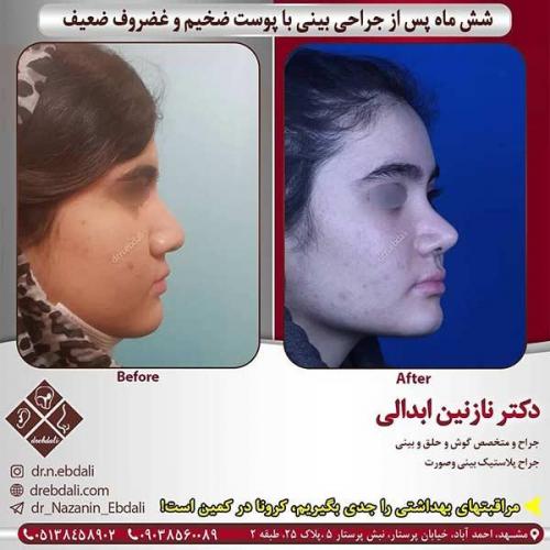 جراحی-بینی-مشهد-238