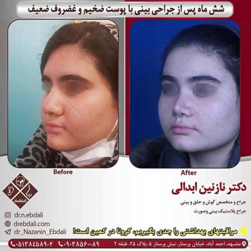 جراحی-بینی-مشهد-239