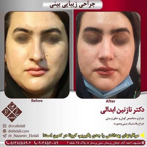 جراحی-بینی-مشهد-241