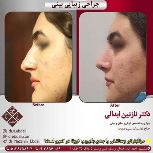 جراحی-بینی-مشهد-242