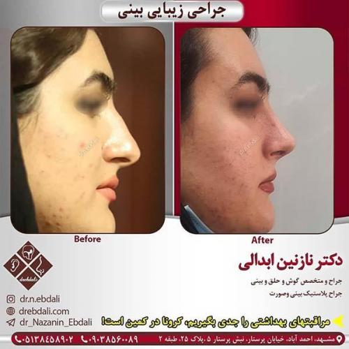 جراحی-بینی-مشهد-243