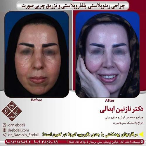جراحی-بینی-مشهد-245