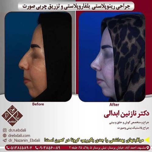 جراحی-بینی-مشهد-246