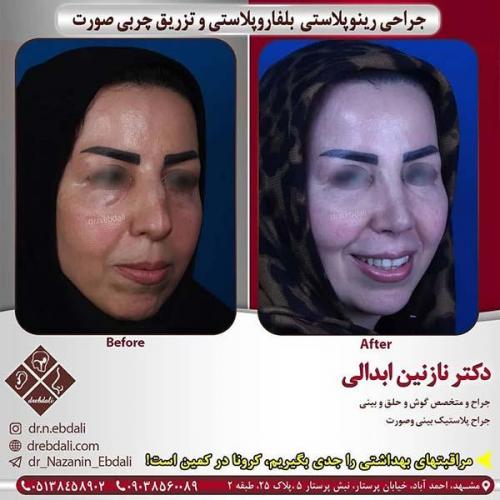 جراحی-بینی-مشهد-247