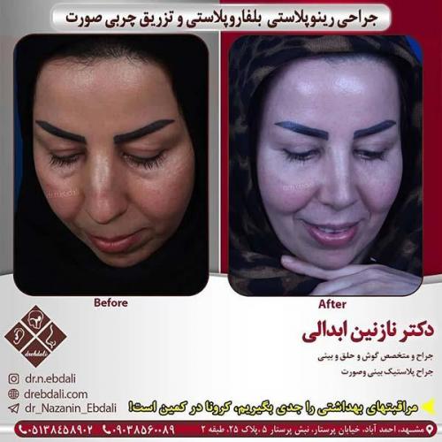 جراحی-بینی-مشهد-248