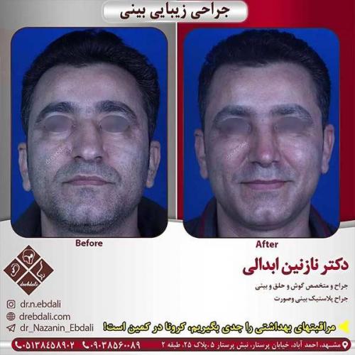 جراحی-بینی-مشهد-250