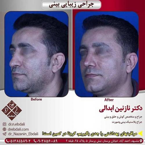 جراحی-بینی-مشهد-251