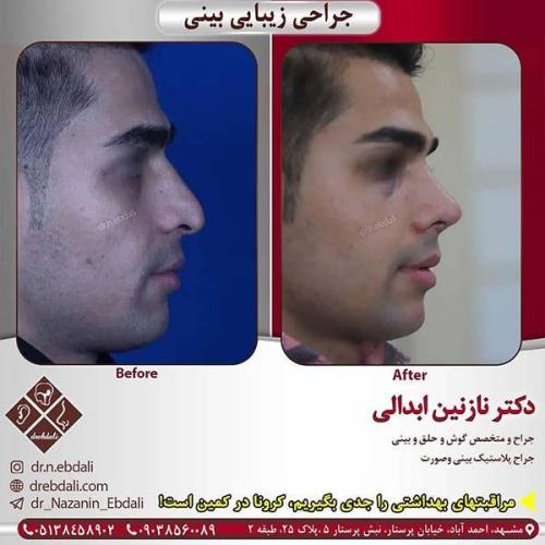 جراحی-بینی-مشهد-254